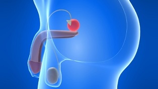 masaxe de próstata para a prevención da prostatite