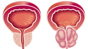 razóns para o desenvolvemento de prostatite e adenoma de próstata